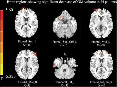 Functional Connectivity Abnormalities of Brain Regions With Structural Deficits in Primary Insomnia Patients